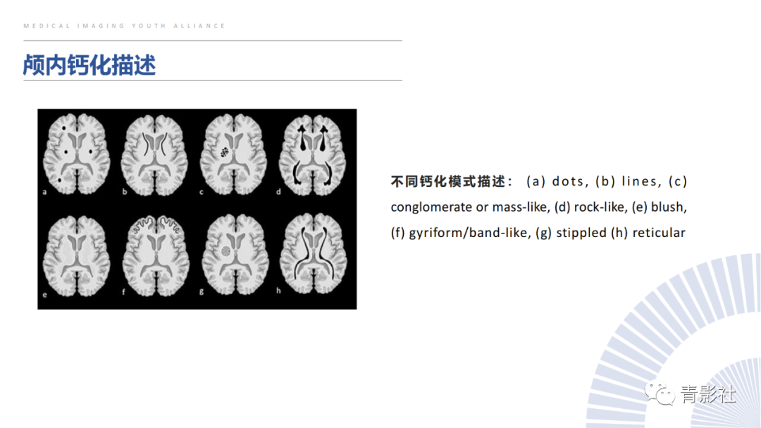 影像PPT - 【PPT】颅内钙化病变的影像诊断思路-6