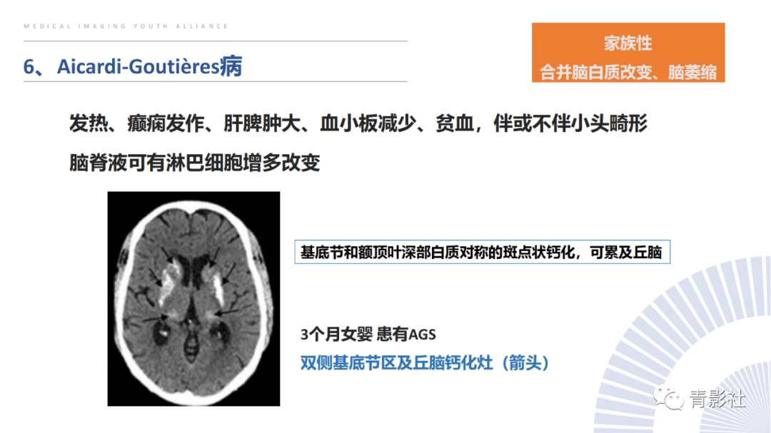 影像PPT - 【PPT】颅内钙化病变的影像诊断思路-15