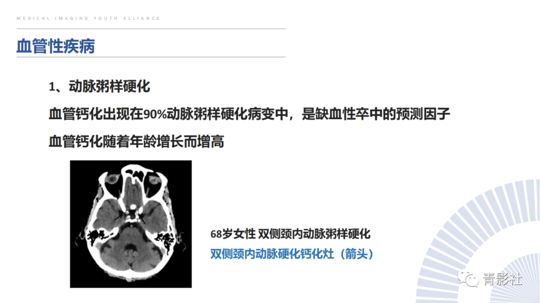 影像PPT - 【PPT】颅内钙化病变的影像诊断思路-24