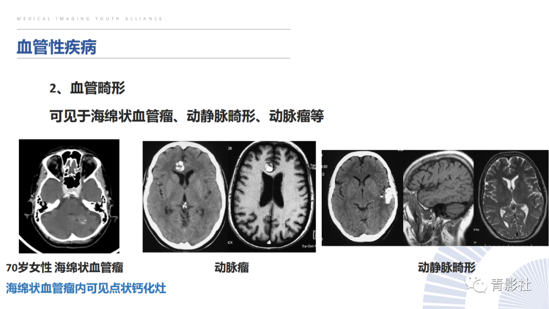 影像PPT - 【PPT】颅内钙化病变的影像诊断思路-25
