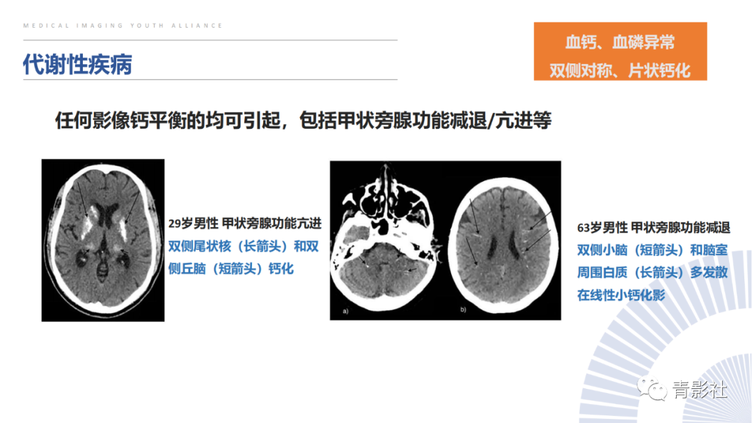 影像PPT - 【PPT】颅内钙化病变的影像诊断思路-35
