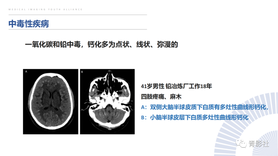 影像PPT - 【PPT】颅内钙化病变的影像诊断思路-38