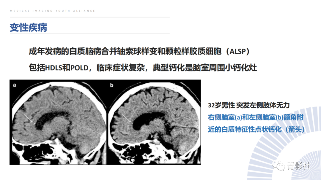 影像PPT - 【PPT】颅内钙化病变的影像诊断思路-39