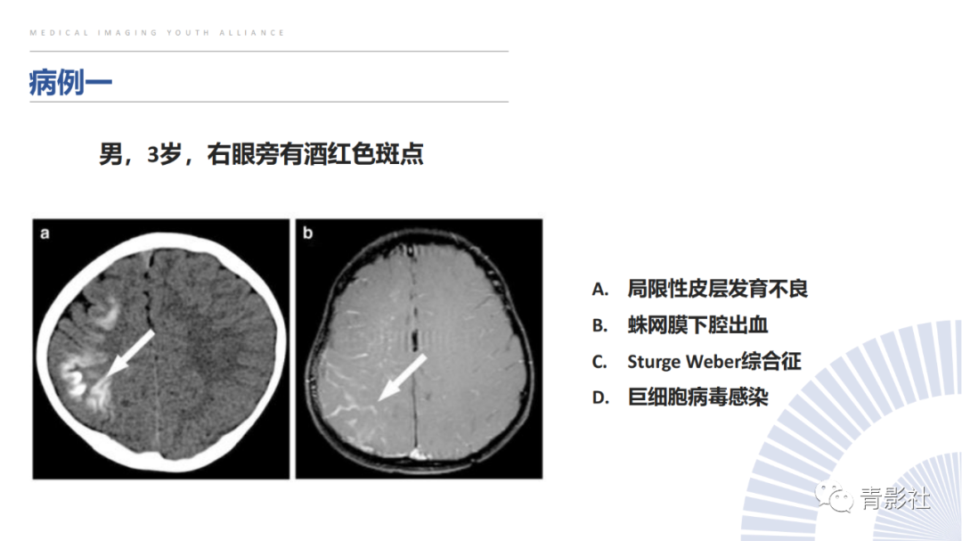 影像PPT - 【PPT】颅内钙化病变的影像诊断思路-44