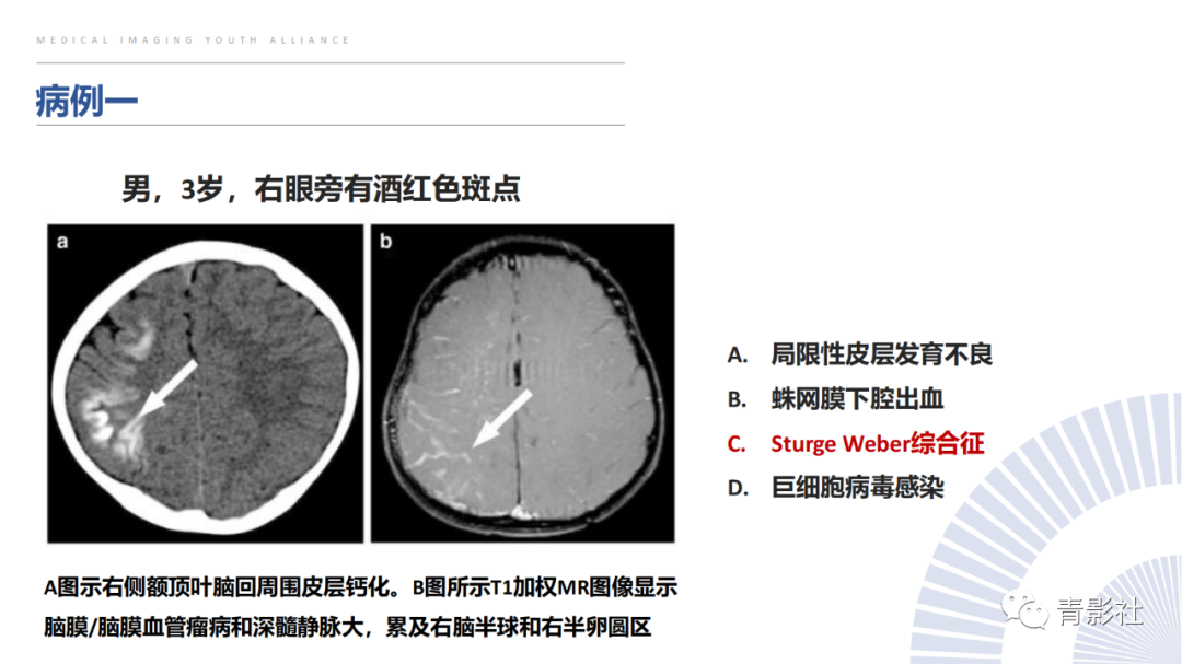 影像PPT - 【PPT】颅内钙化病变的影像诊断思路-45