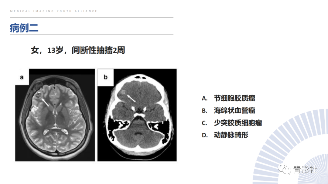 影像PPT - 【PPT】颅内钙化病变的影像诊断思路-46