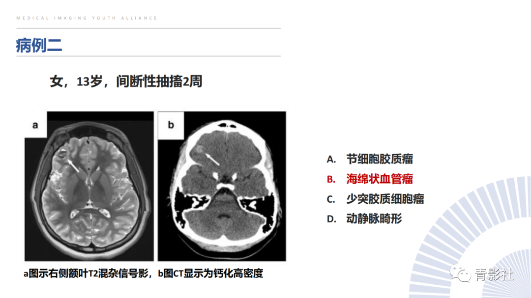 影像PPT - 【PPT】颅内钙化病变的影像诊断思路-47