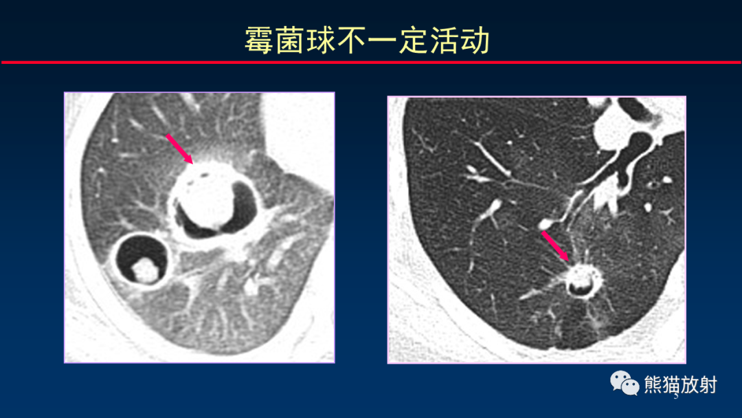 影像PPT - 【PPT】肺真菌感染的CT征象再分析-5