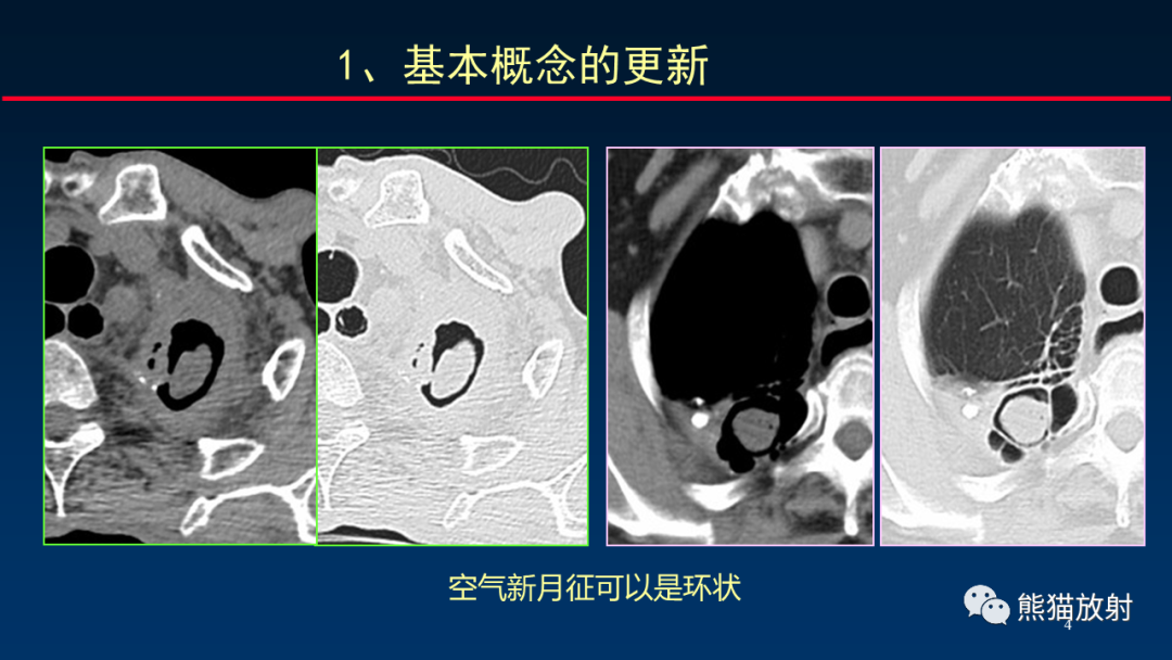 影像PPT - 【PPT】肺真菌感染的CT征象再分析-4