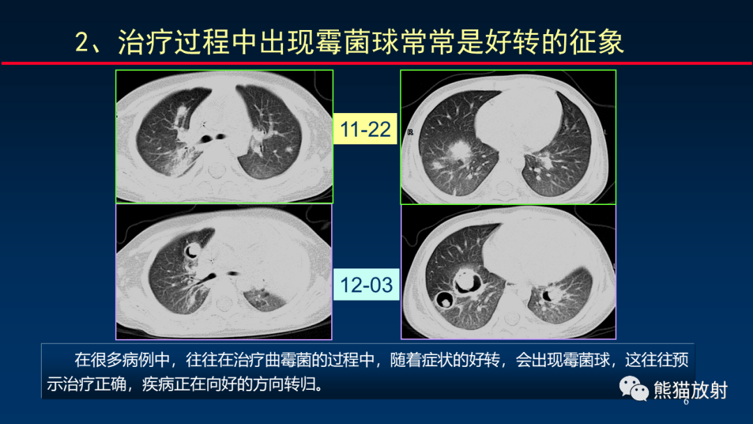 影像PPT - 【PPT】肺真菌感染的CT征象再分析-6
