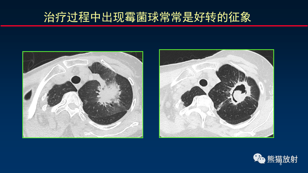 影像PPT - 【PPT】肺真菌感染的CT征象再分析-8