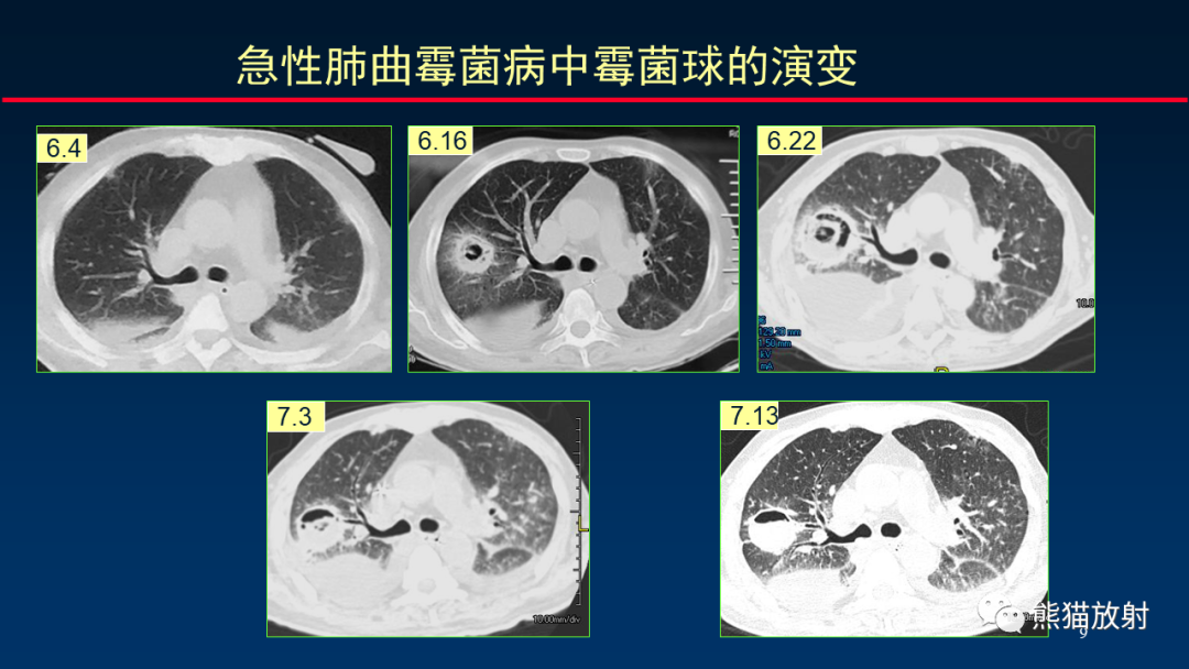 影像PPT - 【PPT】肺真菌感染的CT征象再分析-9