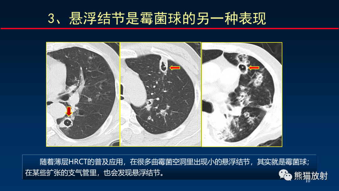 影像PPT - 【PPT】肺真菌感染的CT征象再分析-10
