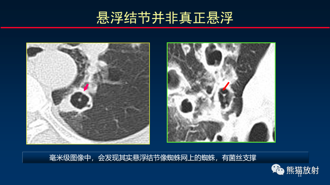 影像PPT - 【PPT】肺真菌感染的CT征象再分析-11