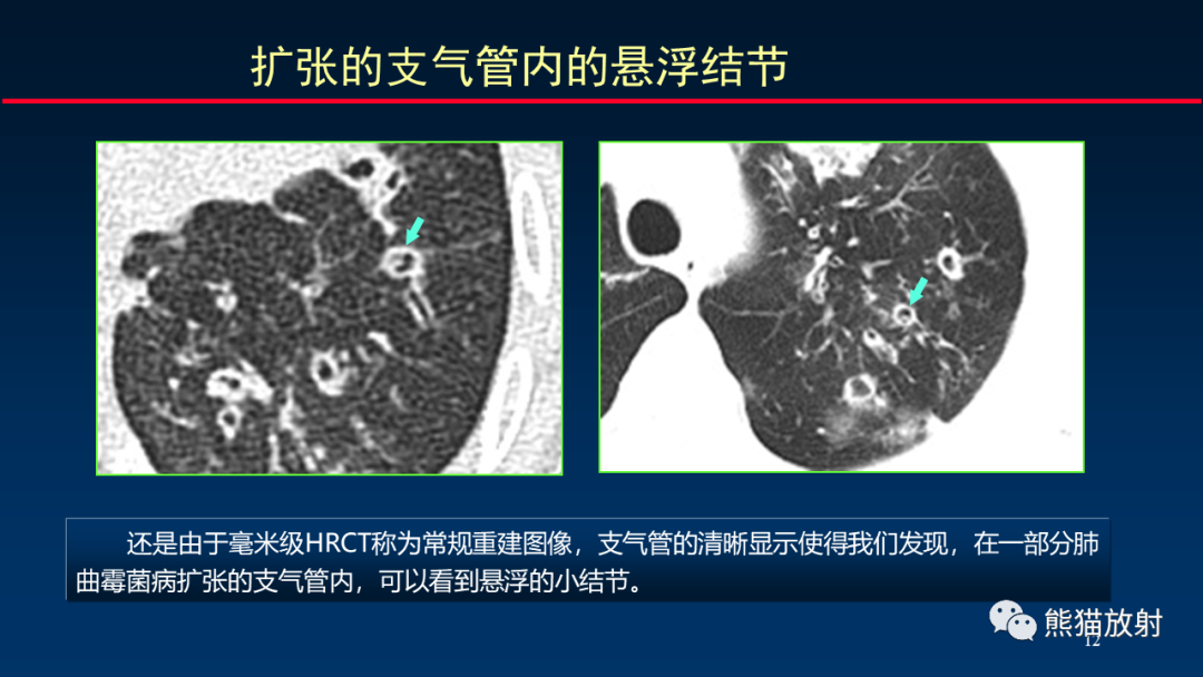 影像PPT - 【PPT】肺真菌感染的CT征象再分析-12