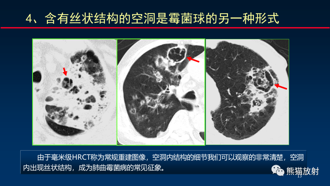 影像PPT - 【PPT】肺真菌感染的CT征象再分析-13