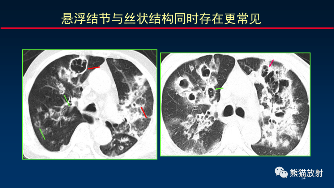 影像PPT - 【PPT】肺真菌感染的CT征象再分析-14