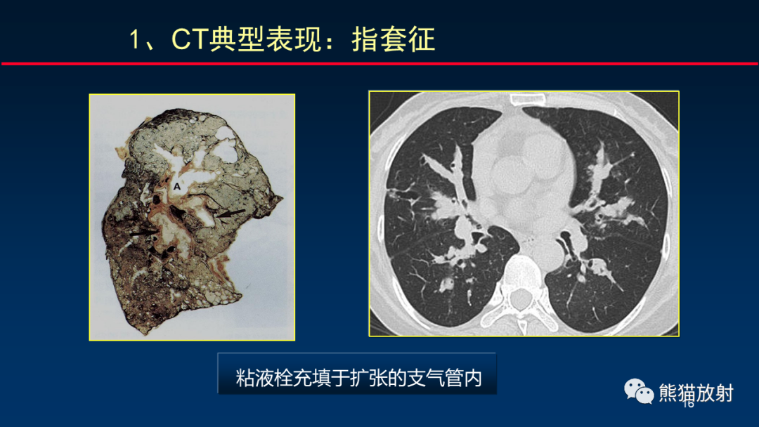 影像PPT - 【PPT】肺真菌感染的CT征象再分析-16
