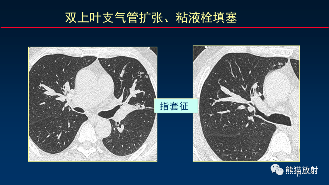 影像PPT - 【PPT】肺真菌感染的CT征象再分析-17