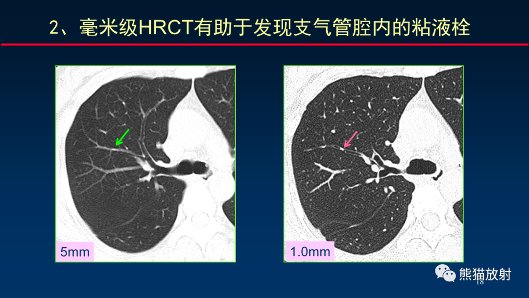 影像PPT - 【PPT】肺真菌感染的CT征象再分析-18