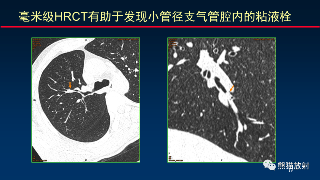 影像PPT - 【PPT】肺真菌感染的CT征象再分析-19