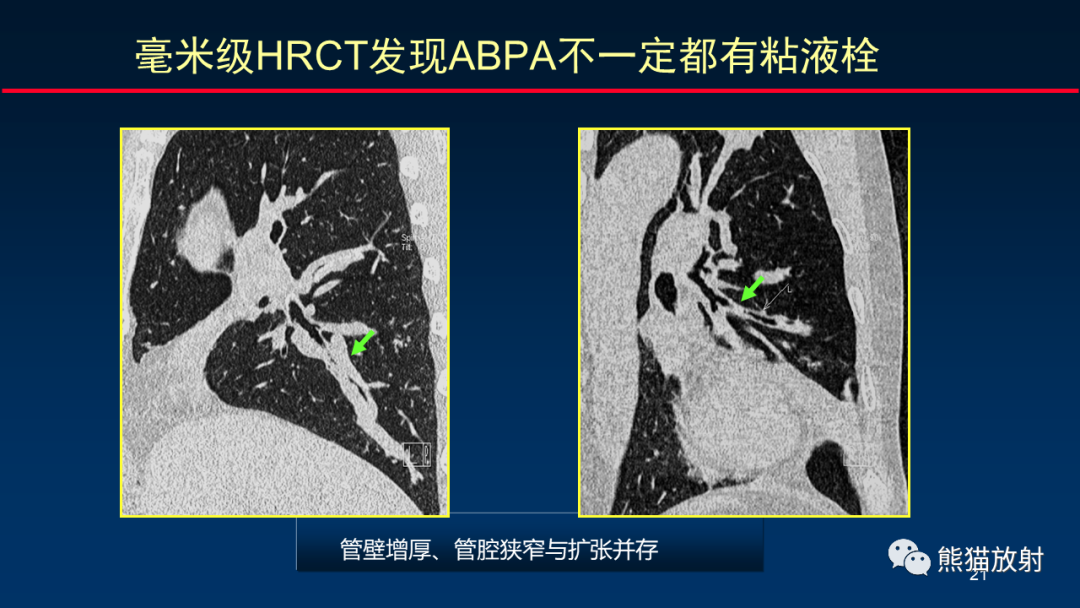 影像PPT - 【PPT】肺真菌感染的CT征象再分析-21