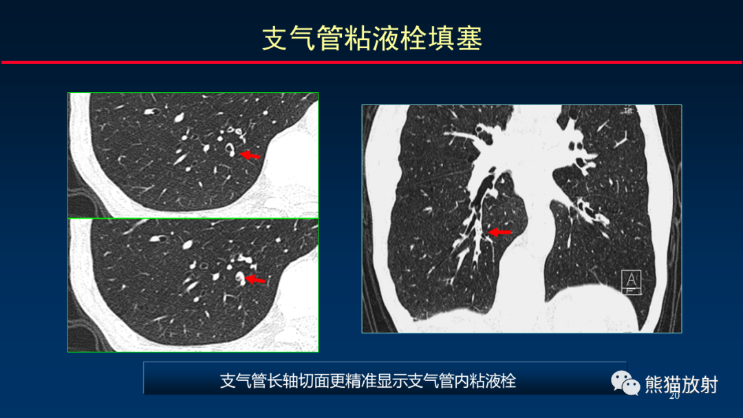 影像PPT - 【PPT】肺真菌感染的CT征象再分析-20