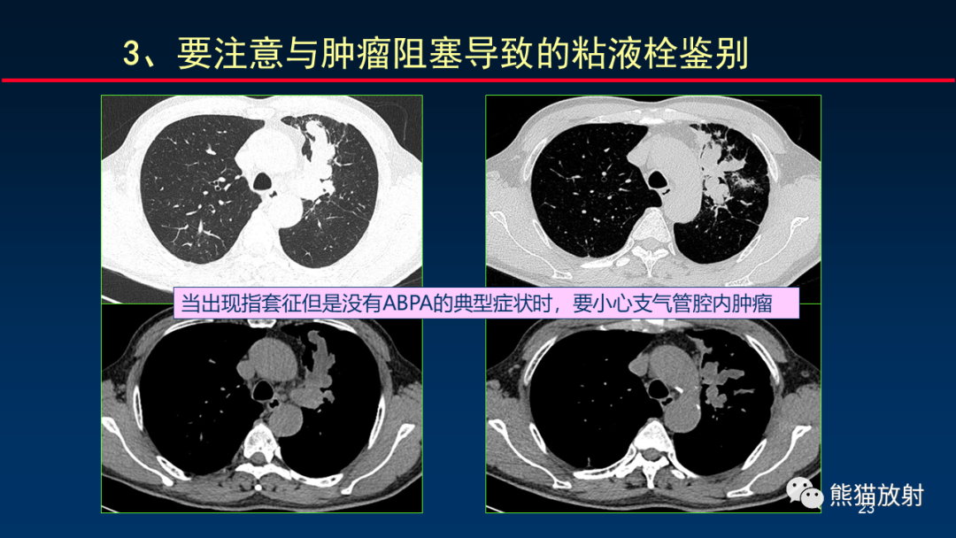 影像PPT - 【PPT】肺真菌感染的CT征象再分析-23