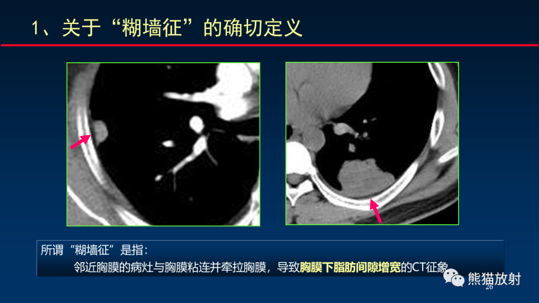 影像PPT - 【PPT】肺真菌感染的CT征象再分析-26
