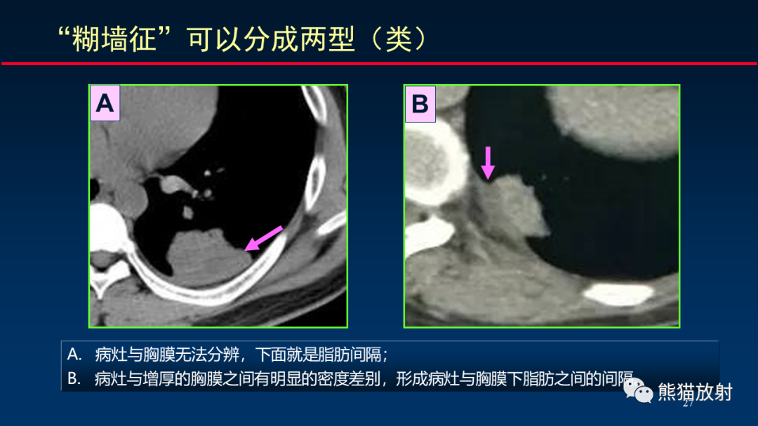 影像PPT - 【PPT】肺真菌感染的CT征象再分析-27