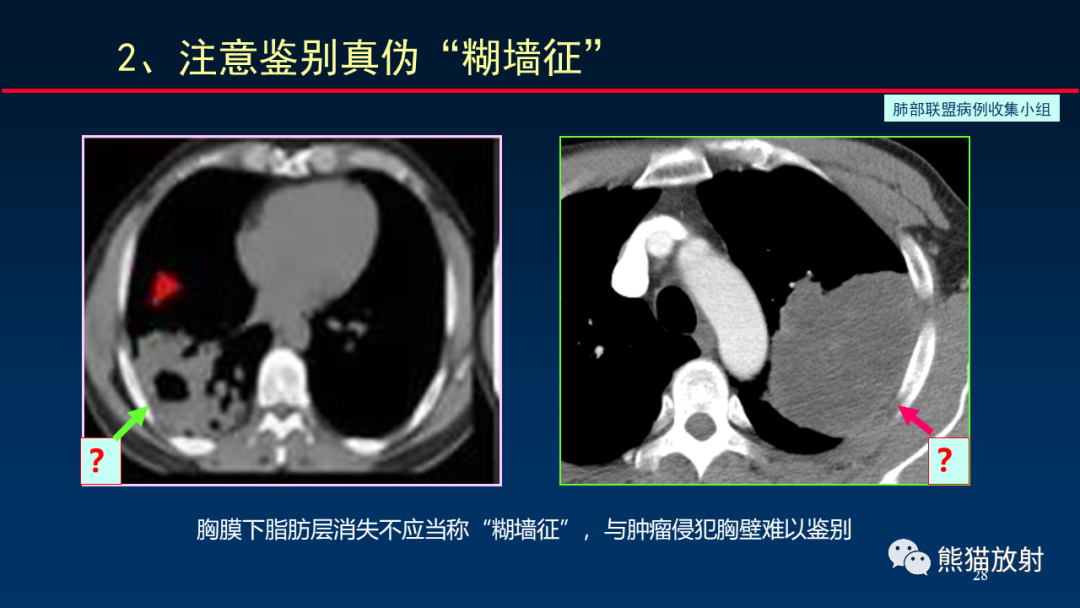 影像PPT - 【PPT】肺真菌感染的CT征象再分析-28