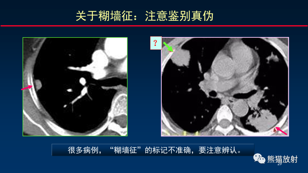 影像PPT - 【PPT】肺真菌感染的CT征象再分析-29