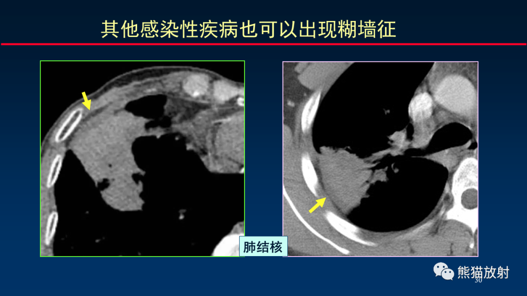 影像PPT - 【PPT】肺真菌感染的CT征象再分析-30