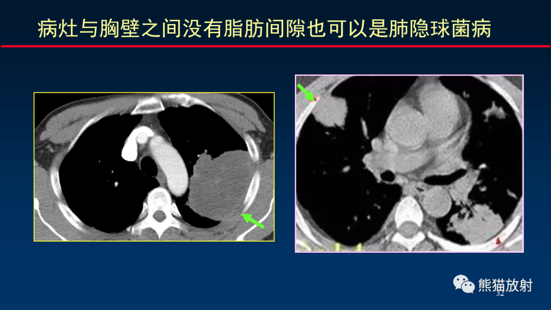 影像PPT - 【PPT】肺真菌感染的CT征象再分析-32