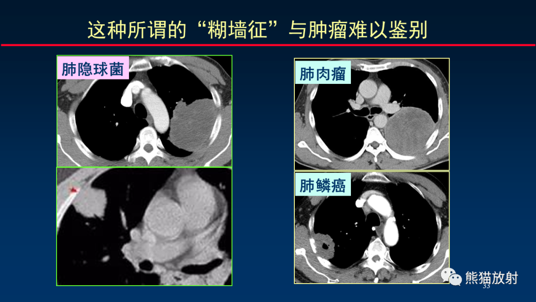 影像PPT - 【PPT】肺真菌感染的CT征象再分析-33