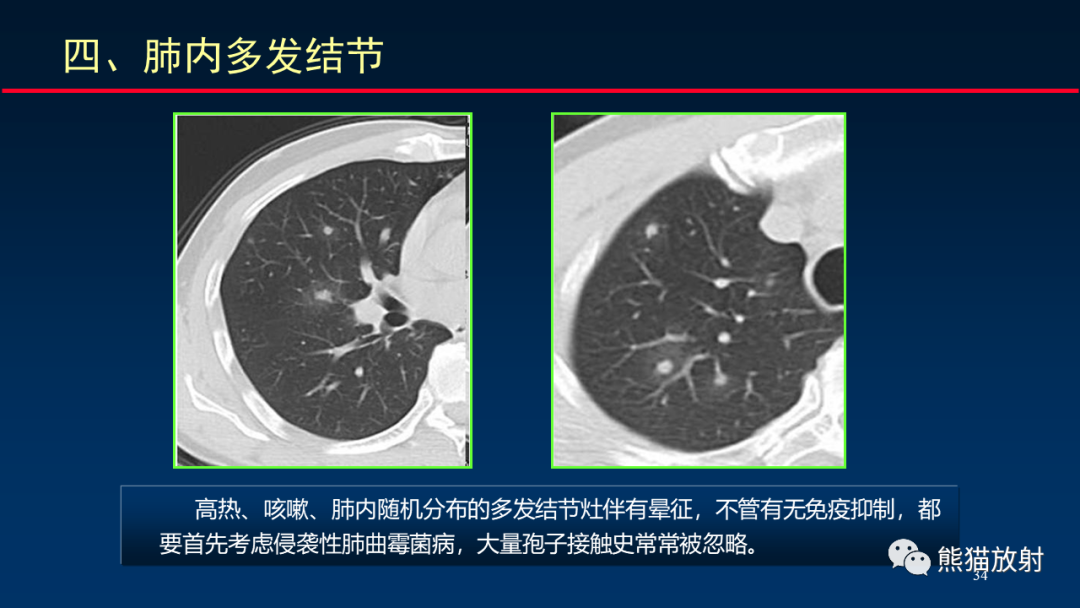影像PPT - 【PPT】肺真菌感染的CT征象再分析-34