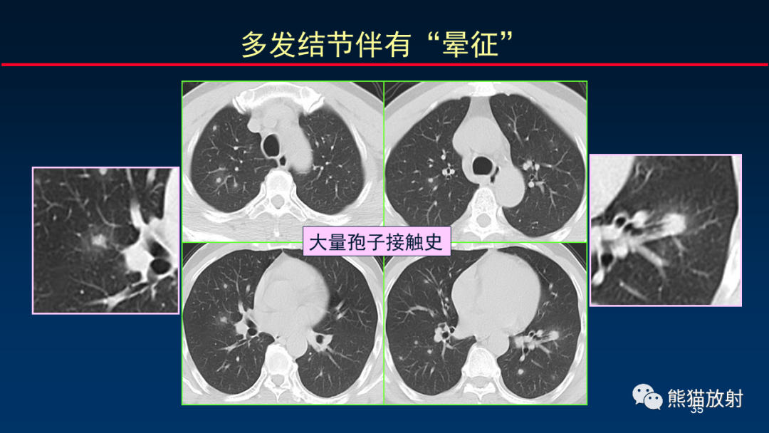 影像PPT - 【PPT】肺真菌感染的CT征象再分析-35