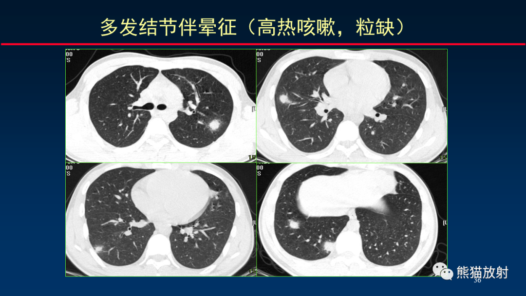 影像PPT - 【PPT】肺真菌感染的CT征象再分析-36