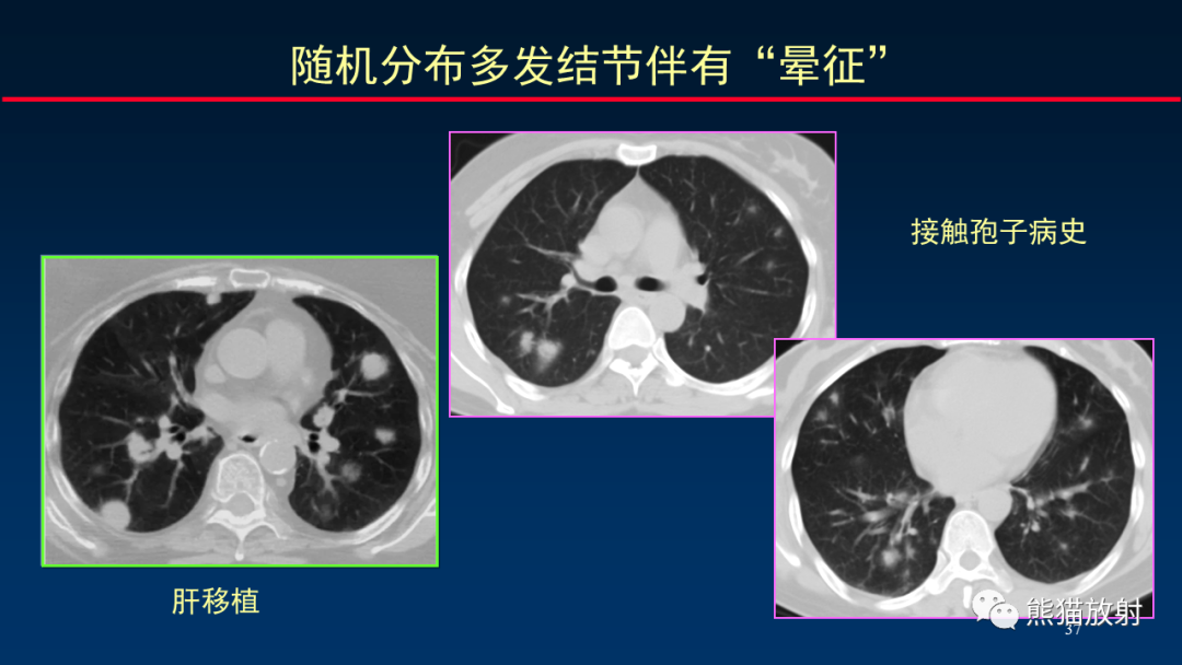 影像PPT - 【PPT】肺真菌感染的CT征象再分析-37