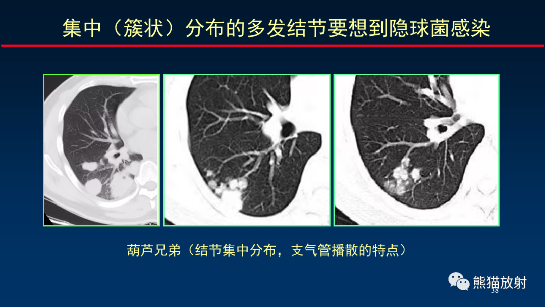 影像PPT - 【PPT】肺真菌感染的CT征象再分析-38