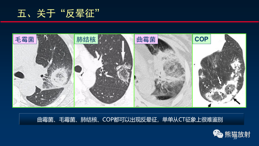 影像PPT - 【PPT】肺真菌感染的CT征象再分析-39