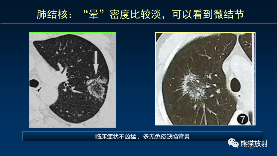影像PPT - 【PPT】肺真菌感染的CT征象再分析-40