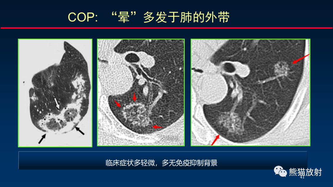 影像PPT - 【PPT】肺真菌感染的CT征象再分析-41