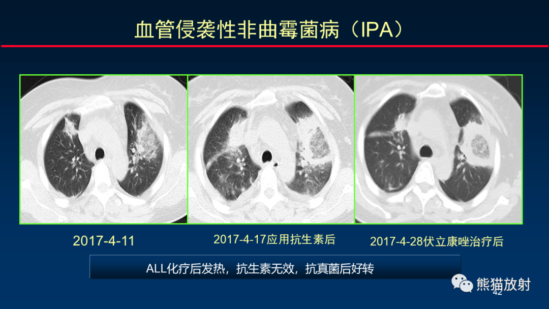 影像PPT - 【PPT】肺真菌感染的CT征象再分析-42