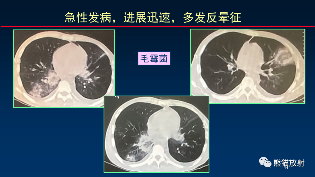 影像PPT - 【PPT】肺真菌感染的CT征象再分析-44