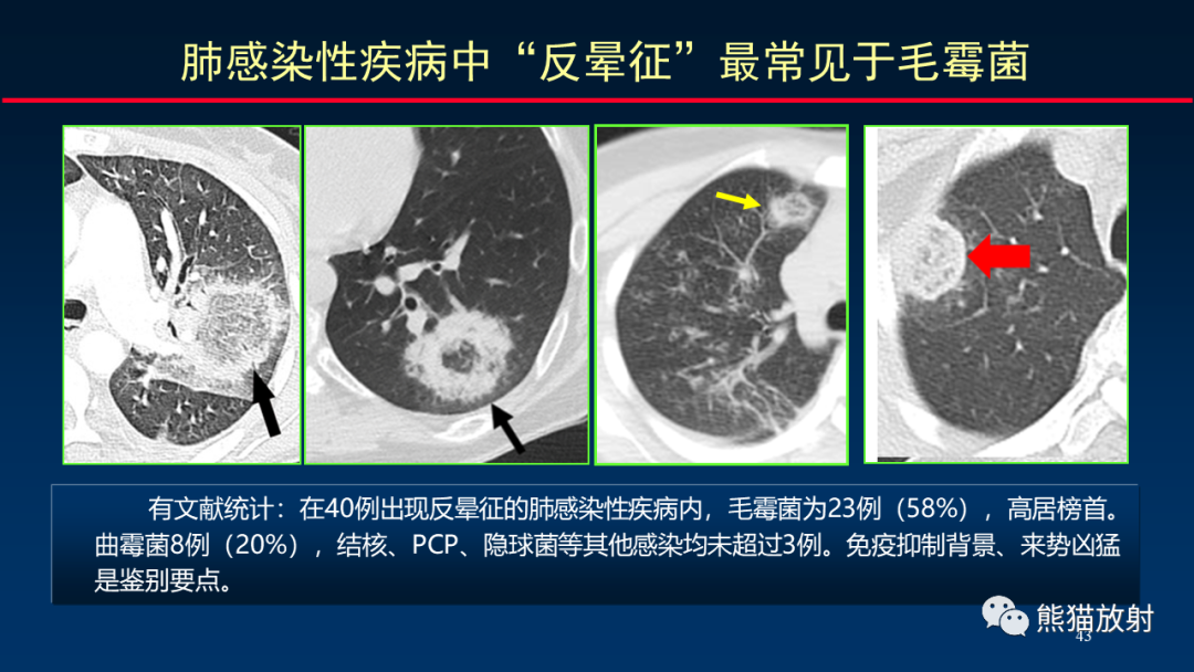 影像PPT - 【PPT】肺真菌感染的CT征象再分析-43