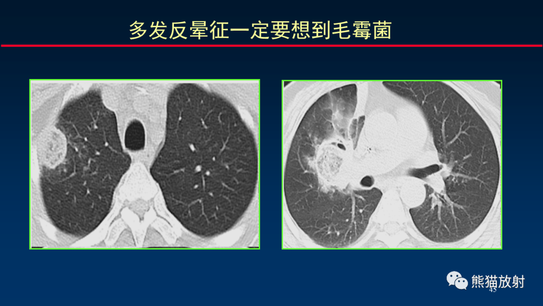影像PPT - 【PPT】肺真菌感染的CT征象再分析-45