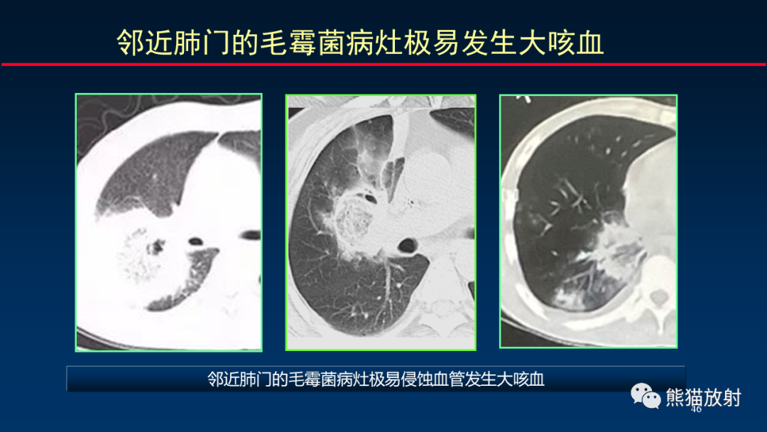 影像PPT - 【PPT】肺真菌感染的CT征象再分析-46
