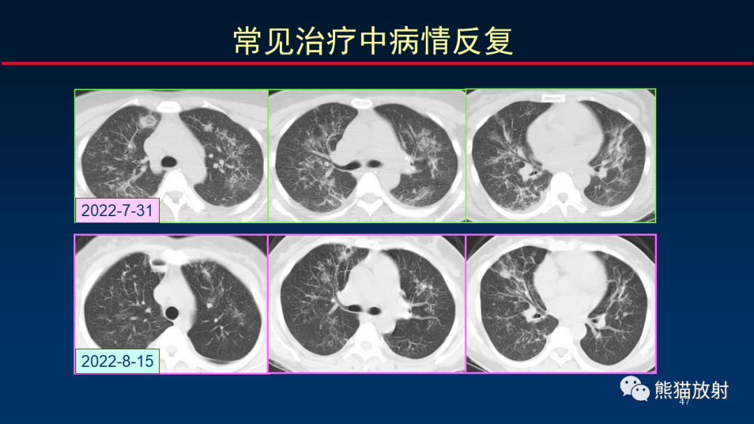 影像PPT - 【PPT】肺真菌感染的CT征象再分析-47