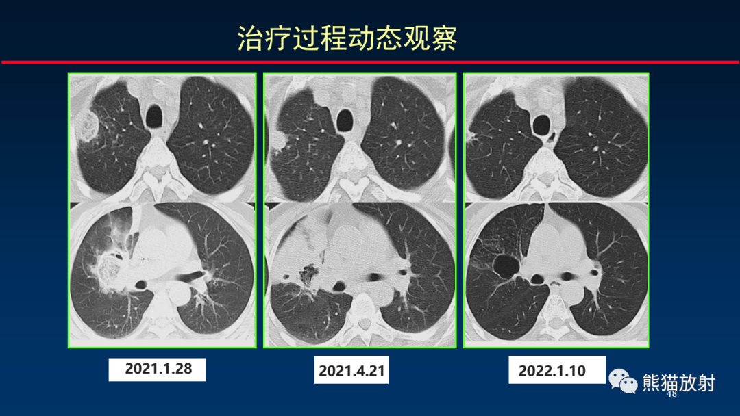 影像PPT - 【PPT】肺真菌感染的CT征象再分析-48